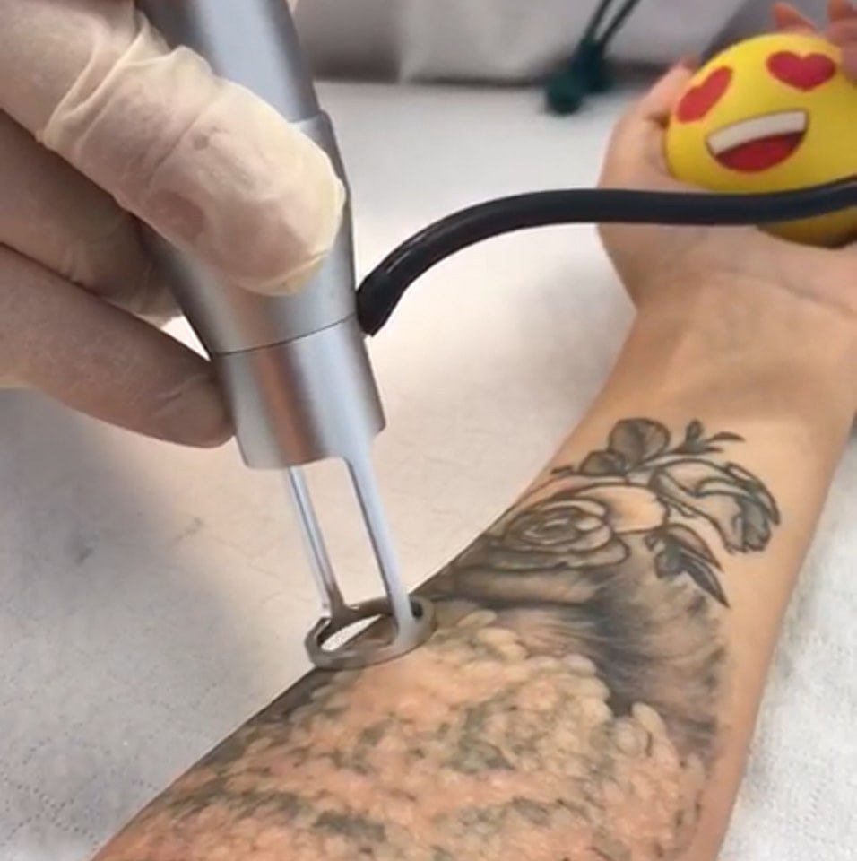 Indepartare Stergere Tatuaj